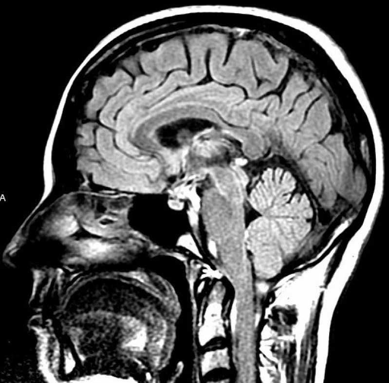 Clínica Que Faz Exame Ressonância Magnética do Crânio Região Central - Exame Rnm Coluna Lombar