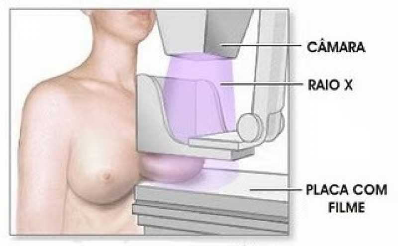 Exame Mamografia Digital Bilateral São Caetano do Sul - Exames Mamografia Convencional