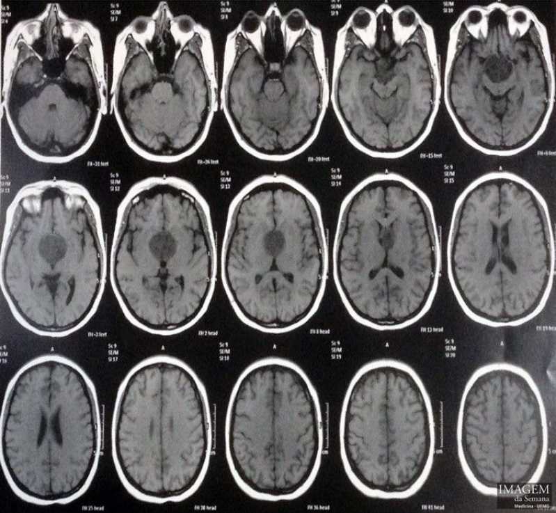 Exame Ressonância Magnética Agendar Mogi das Cruzes - Exame Rm Cranio