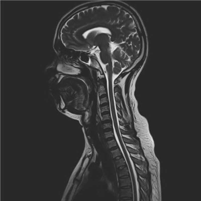 Exame Ressonância Magnética do Crânio Agendar Embu das Artes - Exame Rm Cranio