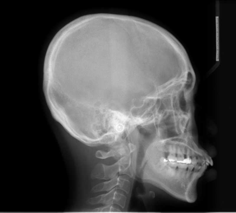 Exame Ressonância Magnética do Crânio Mairiporã - Exame Rm Cranio