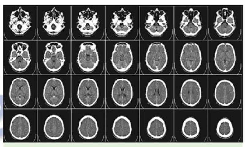 Exame Ressonância Magnética Guarulhos - Exame Rm Cranio