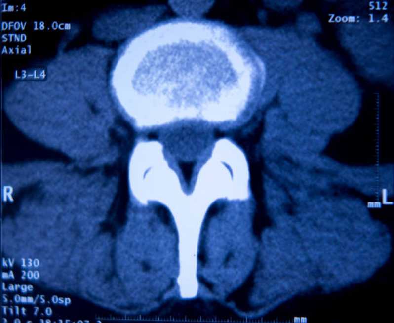 Histerossalpingografia com Sedação Marcar Bela Vista - Histerossalpingografia Endometriose