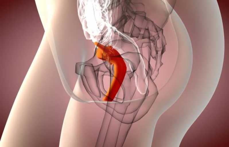 Histerossalpingografia Virtual Marcar Caieiras - Histerossalpingografia Endometriose