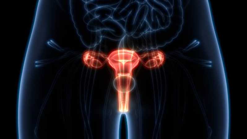 Histerossalpingografia Virtual Vila Pirajussara - Histerossalpingografia Endometriose