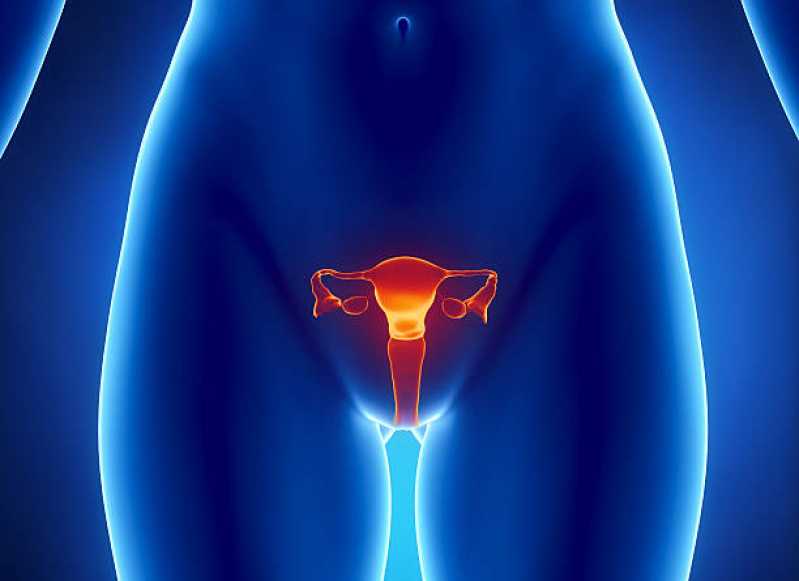 Histerossalpingografia Santana de Parnaíba - Histerossalpingografia Endometriose