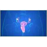 histerossalpingografia endometriose marcar Santa Isabel